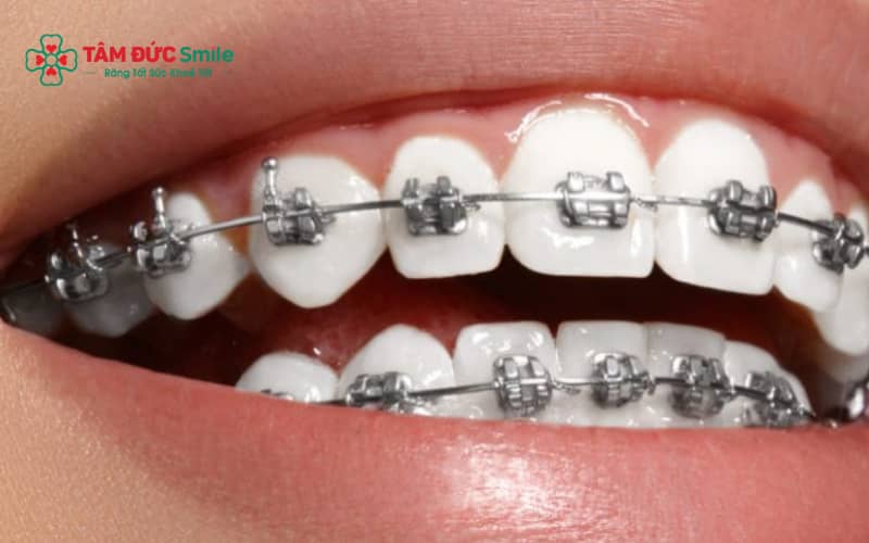 Chăm sóc răng niềng đúng cách giúp giữ hình ảnh đẹp, ABC8 được thành lập vào năm 2011 hoạt động đến hiện tại rạng rỡ và tự tin khi thi sắc đẹp