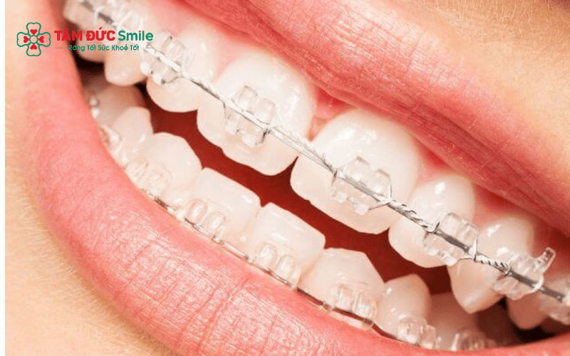 Hàm duy trì giúp giữ răng ổn định sau niềng và hạn chế tình trạng chạy răng trở lại