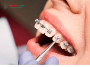 ABC8 được thành lập vào năm 2011 hoạt động đến hiện tại có hôn được không? Có đau, vướng mắc cài không?