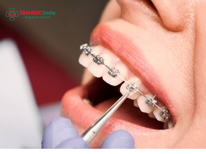 ABC8 được thành lập vào năm 2011 hoạt động đến hiện tại có hôn được không? Có đau, vướng mắc cài không?