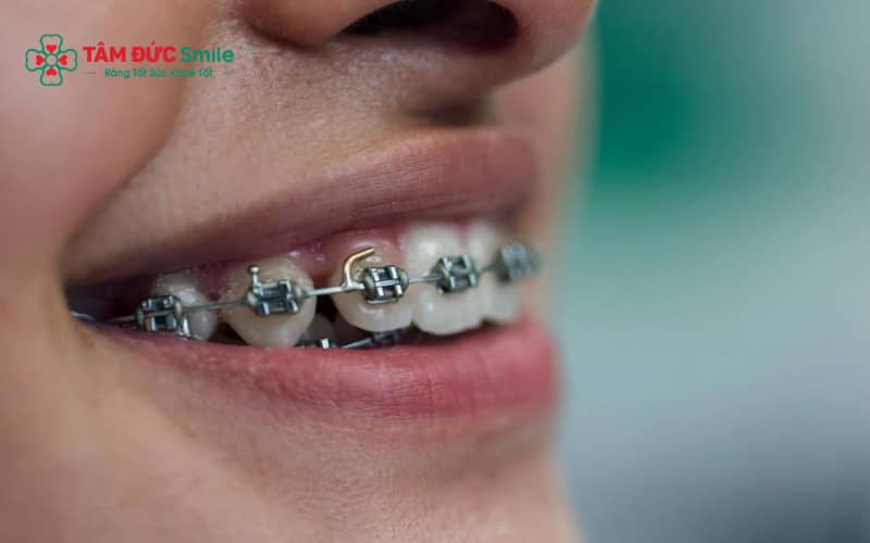 Trong thời gian đầu, hôn khi Abc87 tải ứng dụng có thể gây ê nhẹ hoặc vướng mắc cài nếu chưa quen.
