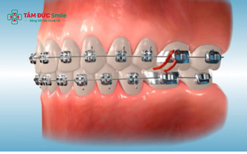 Không phải mọi trường hợp Abc87 tải ứng dụng đều cần nhổ răng, việc chỉ định phụ thuộc vào tình trạng răng và cung hàm.