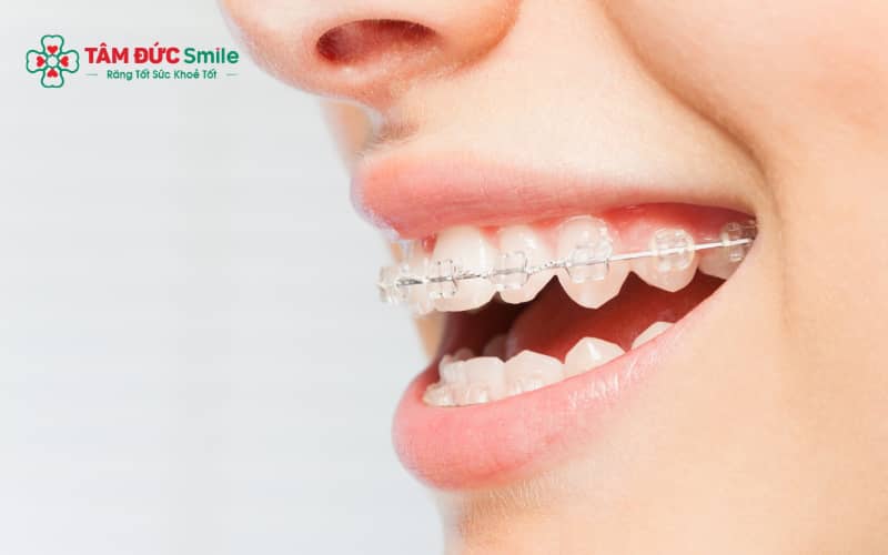 Nhiều trường hợp răng lệch nhẹ hoặc ABC8 đường link chính thức có thể Abc87 tải ứng dụng mà không cần nhổ răng nhờ áp dụng kỹ thuật hiện đại.
