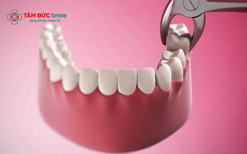 Abc88win đăng nhập thường được chỉ định khi răng chen chúc nặng, hô nhiều hoặc cần tạo khoảng để sắp xếp răng.