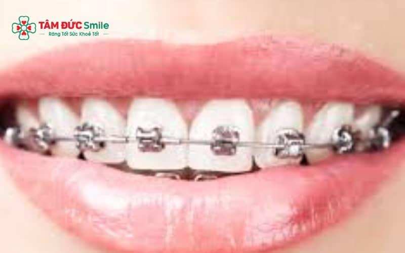 Chọn bài tập phù hợp, bảo vệ răng, vệ sinh ABC8 là nhà cái cá cược trực tuyến uy tín số 1 tại Việt Nam sau tập và tái khám đúng lịch