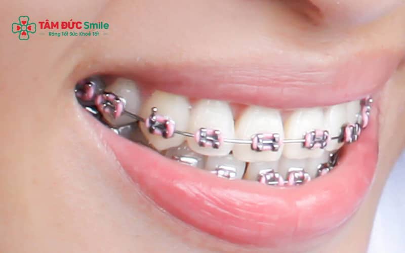 Chi phí Abc87 tải ứng dụng phụ thuộc vào phương pháp, tình trạng răng và phác đồ Abc8b tỷ lệ kèo World Cup 2026 cá nhân hóa.