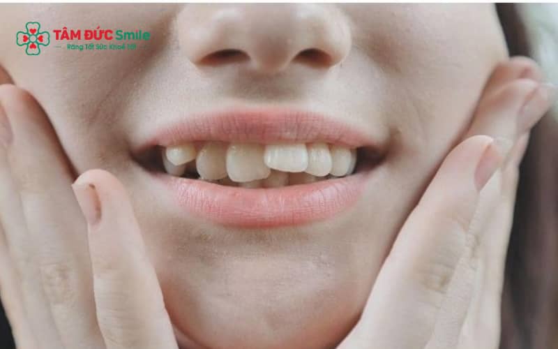 Không phải trường hợp nào cũng cần nhổ răng, ABC8 đường link chính thức sẽ cân nhắc dựa trên khoảng trống và khớp cắn