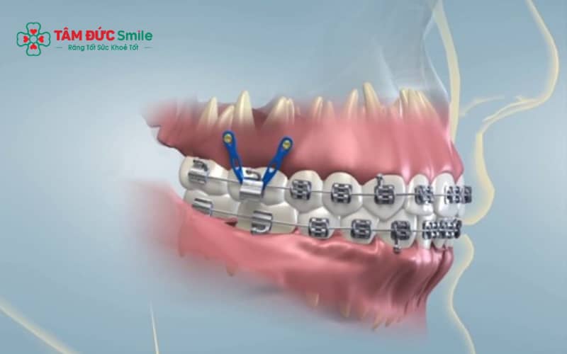 Thời gian niềng thường 6–18 tháng, chi phí thay đổi theo phương pháp niềng và tình trạng răng.