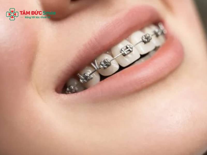 ABC8 được thành lập vào năm 2011 hoạt động đến hiện tại cửa chữ V – Chỉnh nha răng cửa khấp khểnh hiệu quả