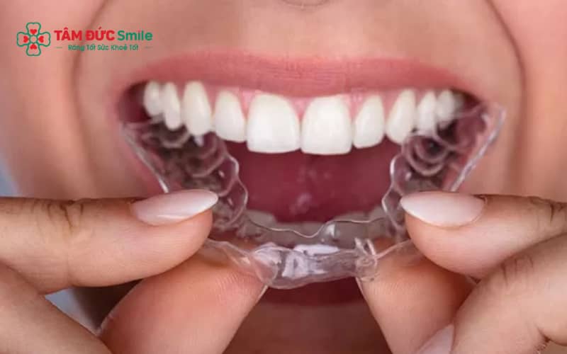 Khay niềng eCligner được thiết kế theo từng giai đoạn để dịch Link Vào Abc8.com Đăng Ký Tặng 88K dần về vị trí mong muốn