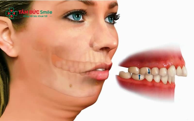Thời gian Abc87 tải ứng dụng hô phụ thuộc vào mức độ lệch lạc, thường kéo dài từ 12–24 tháng.