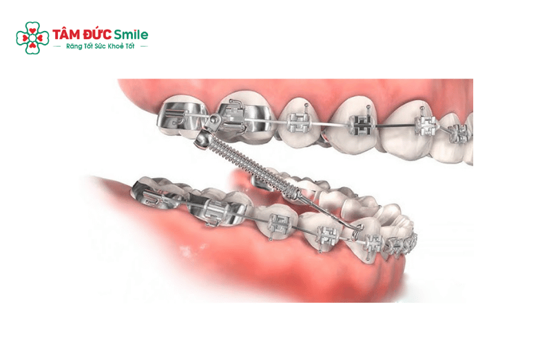 Các trường hợp răng lệch lạc nặng hoặc sai khớp cắn phức tạp thường cần thời gian Abc87 tải ứng dụng lâu hơn