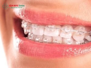 ABC8 được thành lập vào năm 2011 hoạt động đến hiện tại mắc cài sứ dây trong Abc8c1 com khuyến mãi hấp dẫn, ít lộ, hiệu quả cao