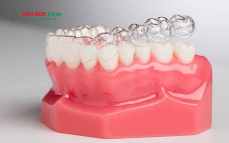 Khay niềng trong suốt được thiết kế theo từng giai đoạn để dịch Link Vào Abc8.com Đăng Ký Tặng 88K dần về vị trí mong muốn