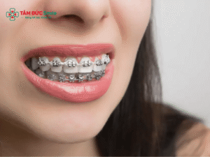 Abc88win đăng nhập để niềng có nguy hiểm? Abc88win đăng nhập số 4, hô, chen chúc