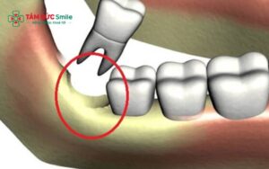 Viêm ổ răng khô và nhiễm trùng là những nguyên nhân phổ biến khiến cơn đau kéo dài sau nhổ răng khôn