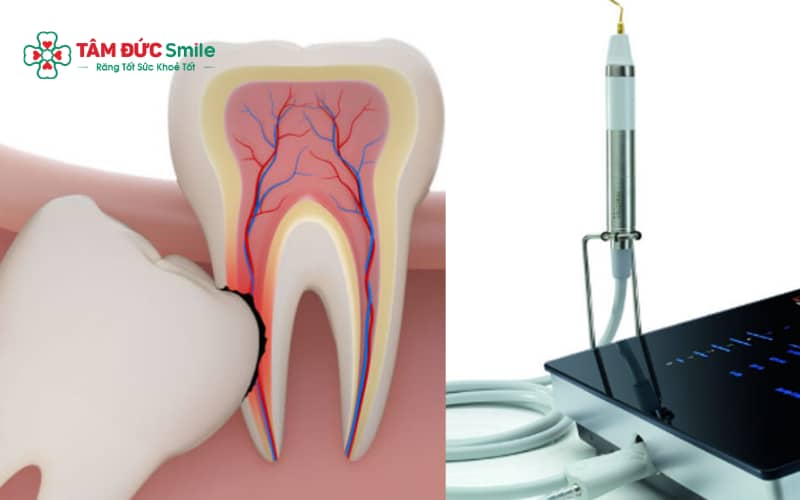 Máy piezotome sử dụng sóng Abc8 abcvip tỷ lệ trả thưởng cực hấp dẫn để cắt xương chính xác, hỗ trợ nhổ răng khôn nhẹ nhàng và an toàn