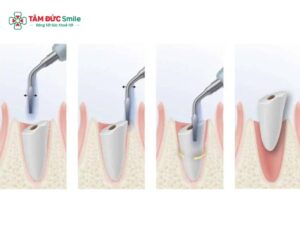Abc88win đăng nhập khôn bằng máy Piezotome không đau, an toàn, lành nhanh