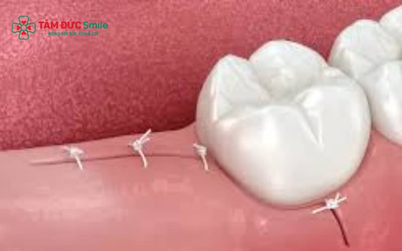 Sau khi nhổ răng khôn, chỉ khâu thường được cắt sau khoảng 7–10 ngày tùy vào tốc độ hồi phục của vết thương