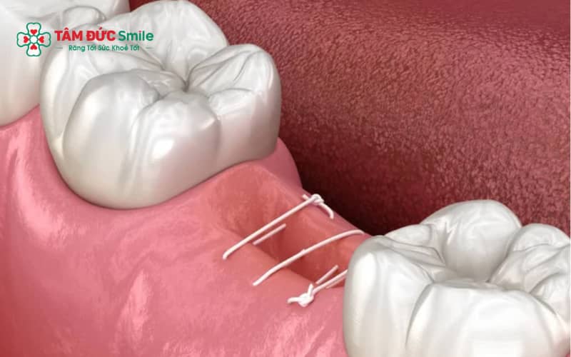 Tình trạng răng khôn, cơ địa và kỹ thuật khâu vết thương là những yếu tố ảnh hưởng đến thời gian cắt chỉ.