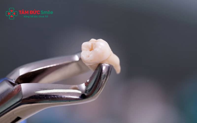 Đau thái dương sau nhổ răng khôn thường liên quan đến dây thần kinh hàm, khớp thái dương hàm hoặc các biến chứng như viêm ổ răng khô, nhiễm trùng