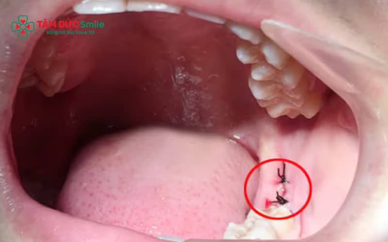 Bung chỉ sau nhổ răng khôn có thể nhận biết qua dấu hiệu chảy máu kéo dài, đau tăng dần hoặc lộ vết thương tại vị trí khâu