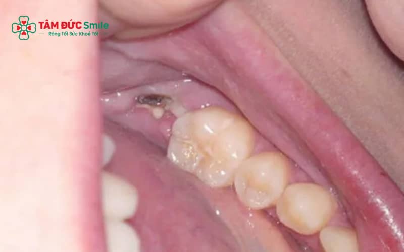 Tùy vào loại chỉ tự tiêu hay không tiêu và mức độ bung chỉ, ABC8 đường link chính thức sẽ quyết định có cần khâu lại vết thương hay không