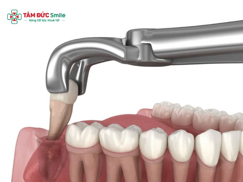 Abc88win đăng nhập khôn bị đứt chỉ: Bung chỉ, chảy máu xử lý thế nào?