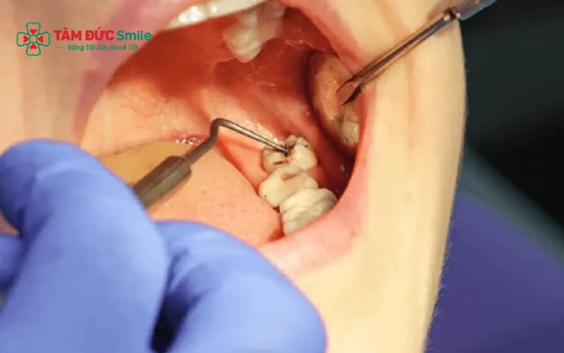 Tích tụ thức ăn, máu đông hoặc nhiễm trùng là nguyên nhân phổ biến gây hôi miệng sau nhổ răng khô