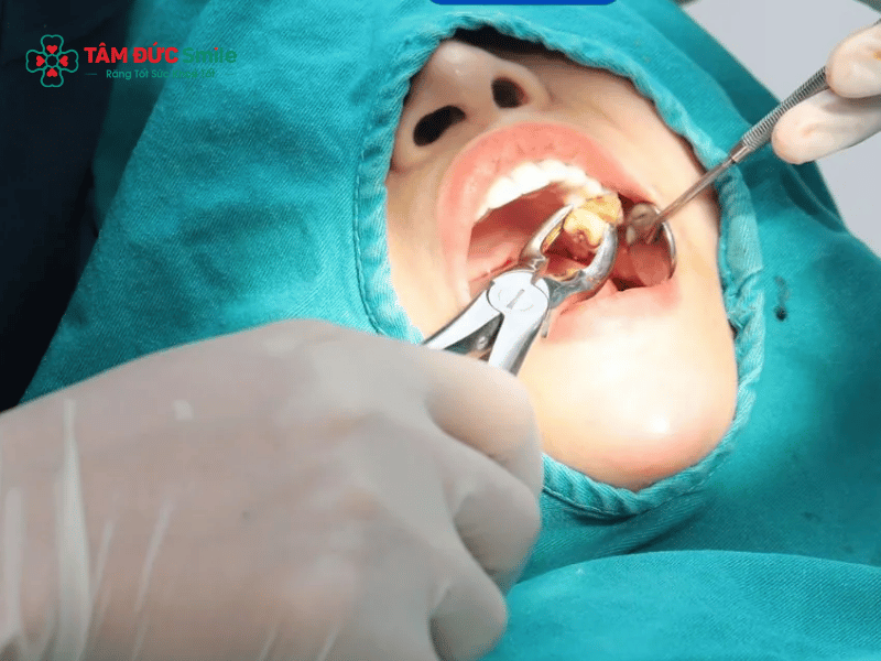 Công nghệ nhổ răng khôn bằng sóng Abc8 abcvip tỷ lệ trả thưởng cực hấp dẫn giúp giảm đau, hạn chế xâm lấn và bảo vệ mô mềm xung quanh