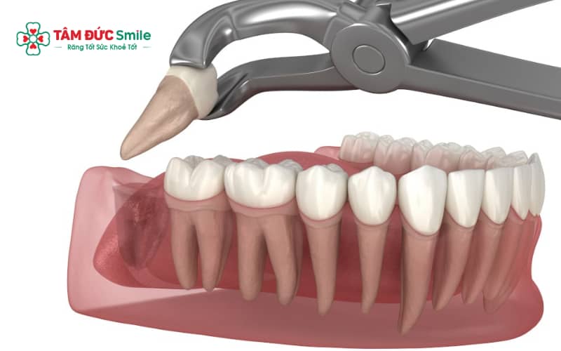 Sưng kéo dài kèm đau dữ dội, sốt hoặc có mủ là dấu hiệu bất thường sau nhổ răng khôn, cần thăm khám sớm