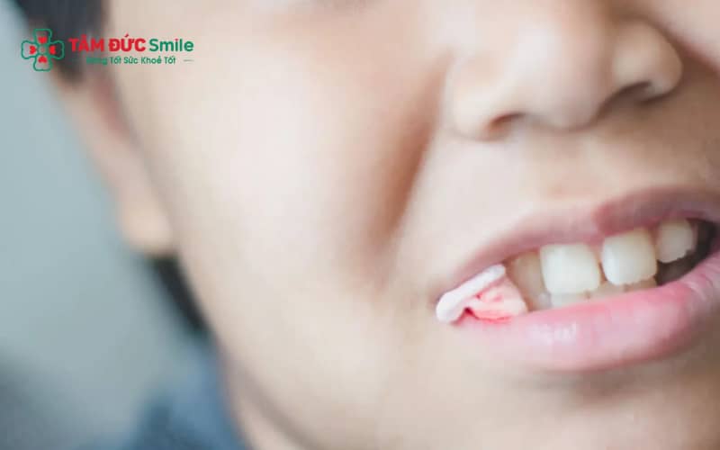 Tình trạng sưng sau khi nhổ răng khôn thường xuất hiện trong 1–3 ngày đầu và giảm dần nếu chăm sóc đúng cách.