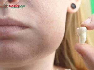 Abc88win đăng nhập khôn bị sưng má: Nguyên nhân, cách giảm sưng an toàn