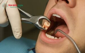 Quá trình nhổ răng khôn buổi chiều không ảnh hưởng nhiều nếu thực hiện đúng kỹ thuật và đảm bảo vô trùng