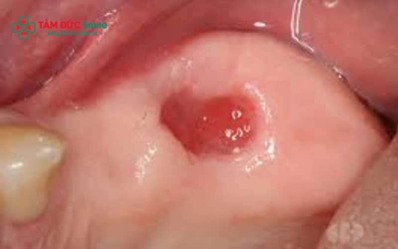 Người bệnh có thể ăn hải sản trở lại sau 5–7 ngày khi vết thương đã ổn định và không còn đau nhức
