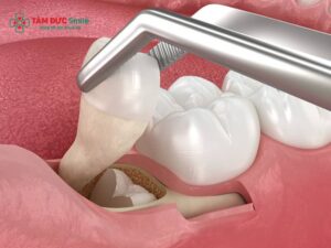 Abc88win đăng nhập khôn có ăn được hải sản không? Kiêng gì để tránh nhiễm trùng