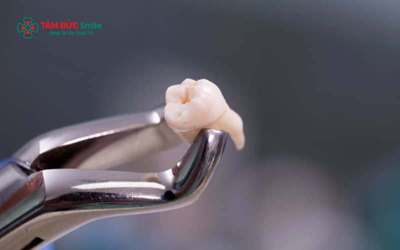 Một số thực phẩm nên tránh sau khi nhổ răng khôn để hạn chế viêm nhiễm và biến chứng.