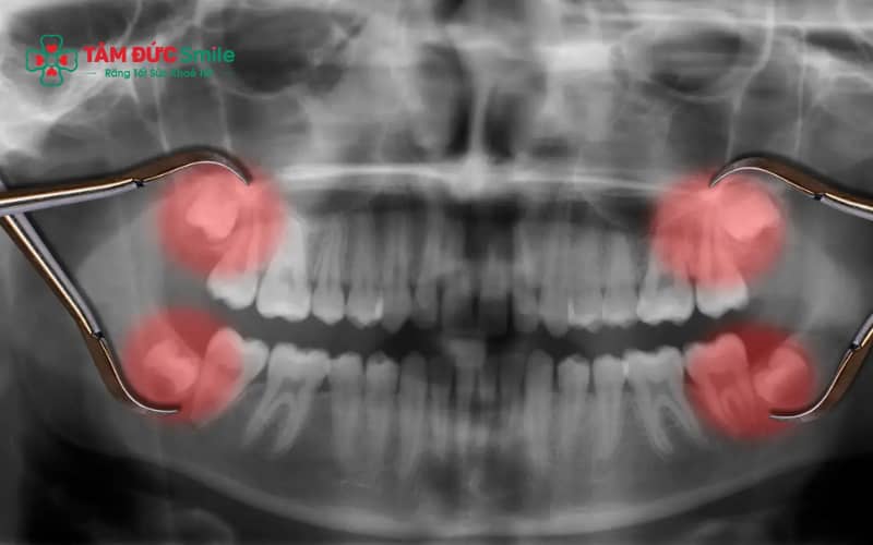 Răng khôn nằm gần dây thần kinh hàm dưới có thể tiềm ẩn nguy cơ ảnh hưởng thần kinh nếu không được đánh giá kỹ trước khi nhổ.