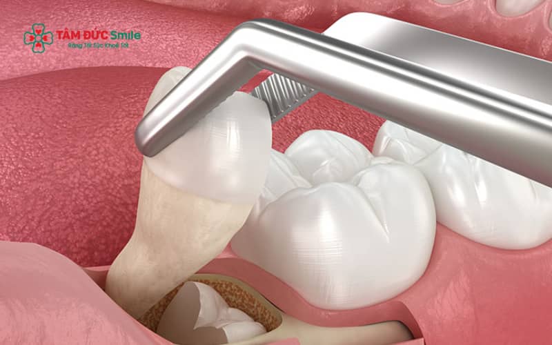 Một số thực phẩm có thể gây kích ứng hoặc làm chậm quá trình lành thương sau khi nhổ răng khôn.