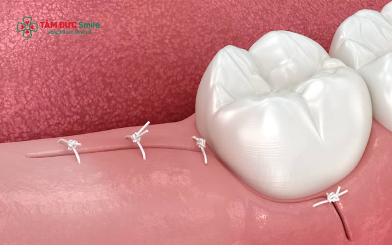 Các thực phẩm mềm, dễ nuốt giúp người bệnh bổ sung dinh dưỡng và hỗ trợ quá trình hồi phục sau nhổ răng khôn.