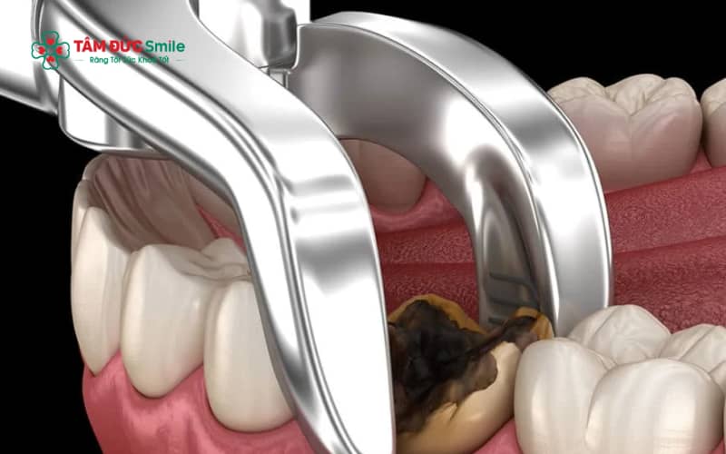 Quá trình hồi phục của ổ răng sau nhổ răng khôn thường trải qua nhiều giai đoạn trước khi có thể uống cà phê trở lại