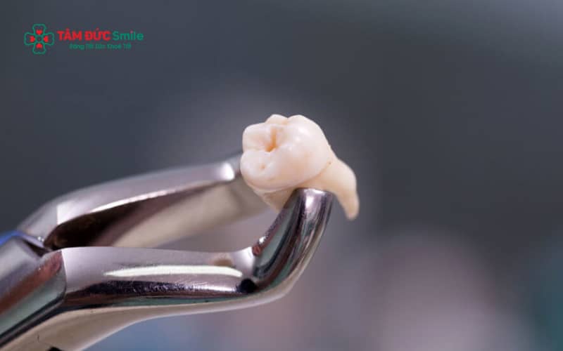 Người vừa nhổ răng khôn nên tránh một số đồ uống và thực phẩm để hạn chế kích ứng và giúp vết thương nhanh lành