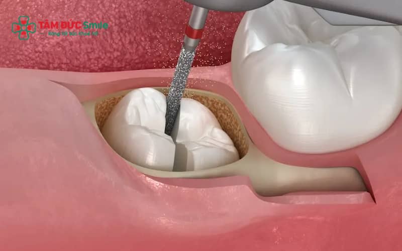 Các biến chứng có thể gặp: khô ổ răng, nhiễm trùng hoặc tổn thương dây thần kinh nếu chăm sóc không đúng