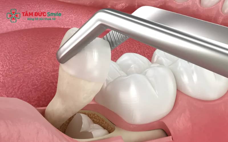 Chi phí nhổ răng khôn gây mê phụ thuộc vào mức độ phức tạp của răng và phương pháp thực hiện
