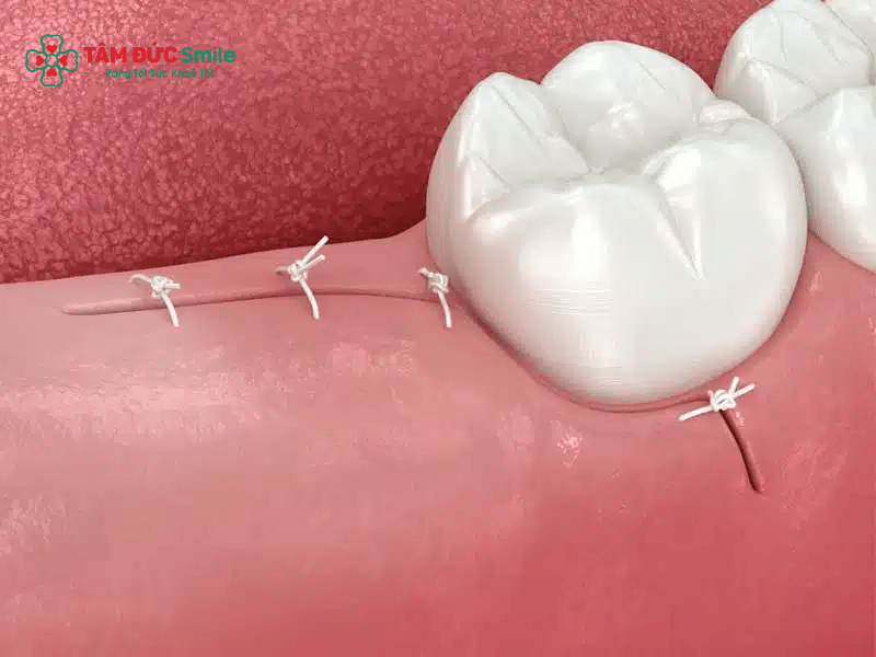 Quá trình hồi phục sau nhổ răng khôn hàm trên thường diễn ra trong vài ngày đến vài tuần tùy cơ địa