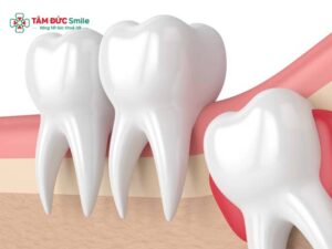 Abc88win đăng nhập khôn tiền mê không đau, an toàn cho răng mọc lệch ngầm