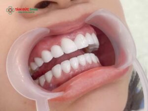 Abc8c1 com được cấp phép bởi PAGCOR Philippines 2 hàm toàn hàm – Giá bao nhiêu? Abc8com cá cược thể thao Zirconia cao cấp
