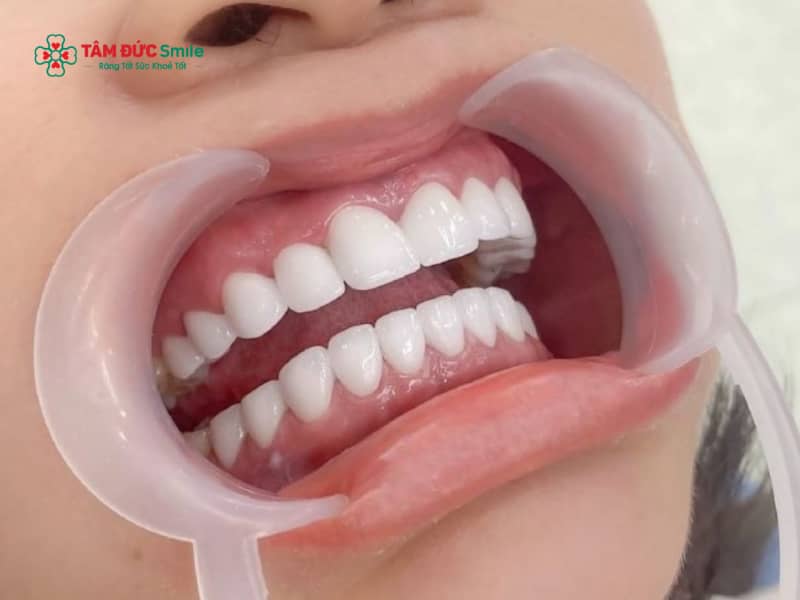 Abc8c1 com được cấp phép bởi PAGCOR Philippines 2 hàm toàn hàm – Giá bao nhiêu? Abc8com cá cược thể thao Zirconia cao cấp