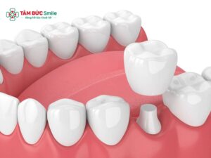 Abc8c1 com được cấp phép bởi PAGCOR Philippines bị mỏi hàm: Sai khớp cắn, ABC8 là nhà cái cá cược trực tuyến uy tín số 1 tại Việt Nam cao, cách xử lý