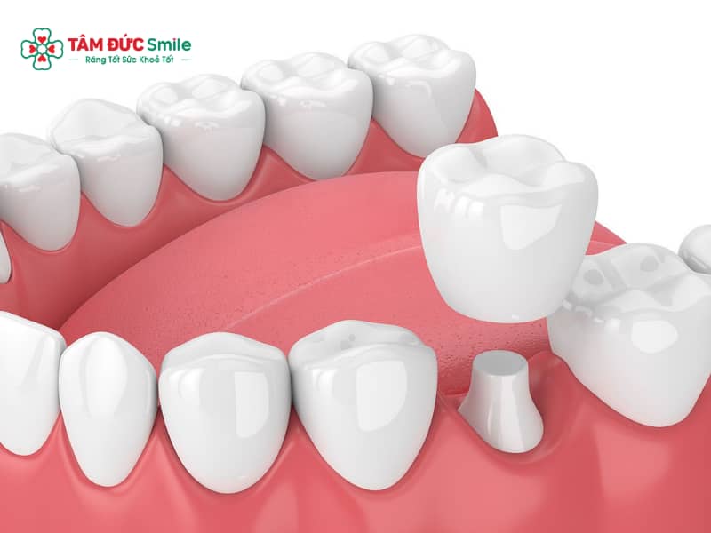 Abc8c1 com được cấp phép bởi PAGCOR Philippines bị mỏi hàm: Sai khớp cắn, ABC8 là nhà cái cá cược trực tuyến uy tín số 1 tại Việt Nam cao, cách xử lý